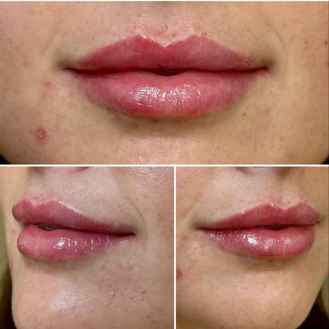 “Lip filler enhancement adding soft, natural volume and shape by Nicole Leiann RN BSN in Aliso Viejo, California.”