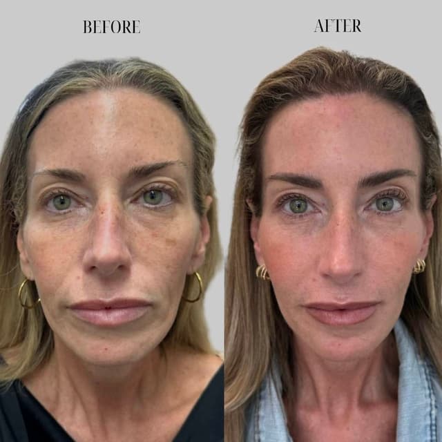 “Turn back time and bring back youthful volume with full-face filler and expert injectables by Nicole Leiann RN BSN in Aliso Viejo.”