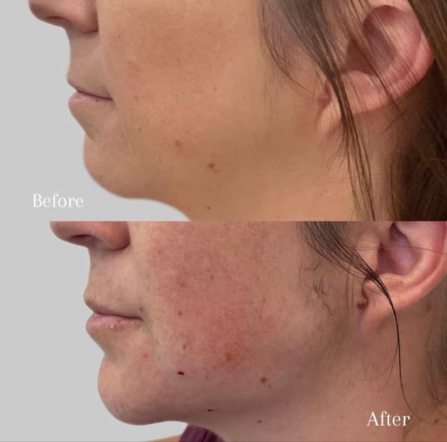 “Don’t forget the power of the chin! Subtle filler creates balance and definition for a total profile glow-up—expertly done by Nicole Leiann RN BSN.”
