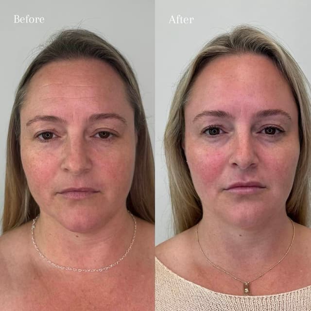 “Full-face filler customized to your own goals for balanced, natural enhancement—expertly tailored by Nicole Leiann RN BSN in Aliso Viejo.”