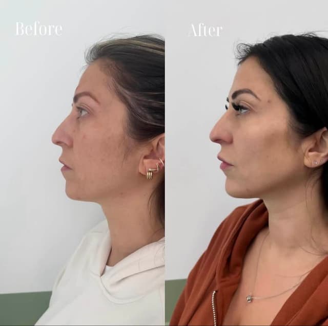 Side profile glow up with natural jawline and chin filler. Always here for balanced, refined results.