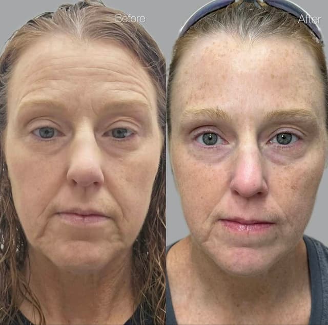 Smooth fine lines and refresh your look with a Botox glow-up—natural, refined results by Nicole Leiann RN BSN in Aliso Viejo.