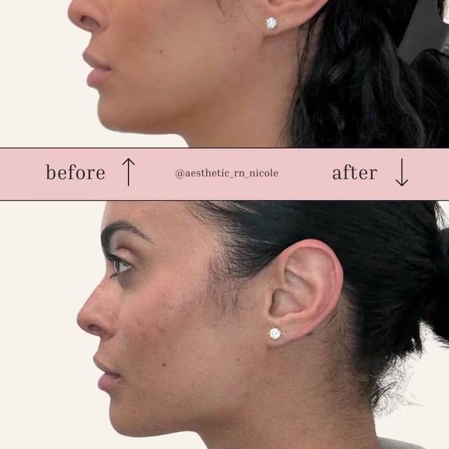 side profile jawline and chin filler before and after