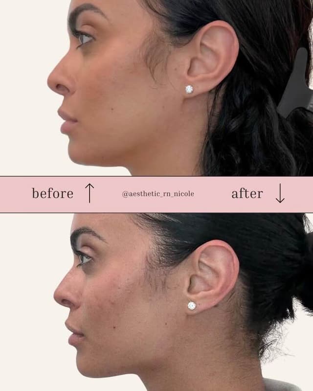 Jawline and chin filler before and after